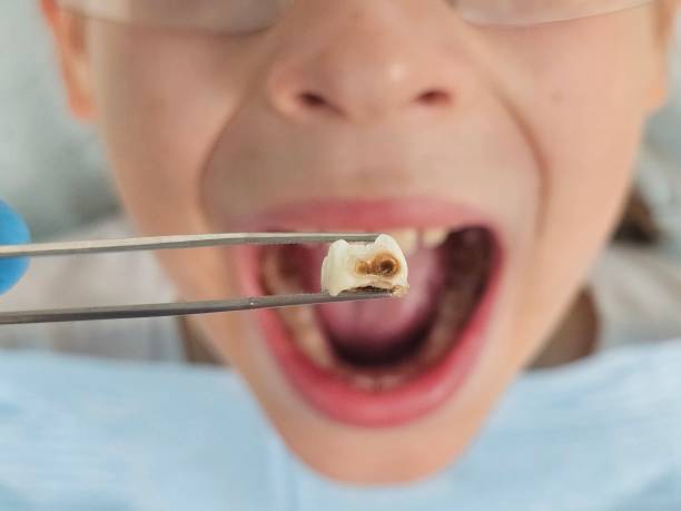 Best Broken or Chipped Tooth Repair in Buckingham, FL